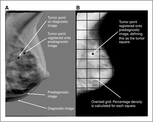 Figure 1. Image registration and tumor location. A, diagnostic and prediagnostic images overlaid on each other, with tumor point identified on diagnostic image. B, prediagnostic image with registered tumor point located on it and overlaid square grid.