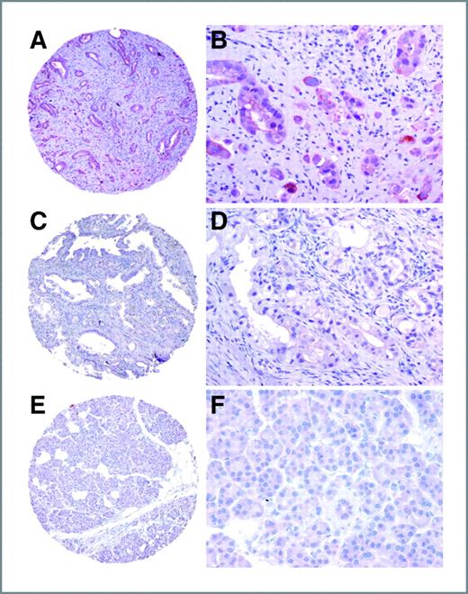Figure 1. Representative micrographs show PP4C expression in PDAC samples and benign pancreatic tissue. A and B, strong cytoplasmic and nuclear staining for PP4C in a moderately to poorly differentiated PDAC. C and D, a moderately differentiated PDAC with weak staining for PP4C. E and F, representative benign pancreatic tissue that is negative for PP4C (original magnification, ×40 for A, C, and E; ×200 for B, D, and F).