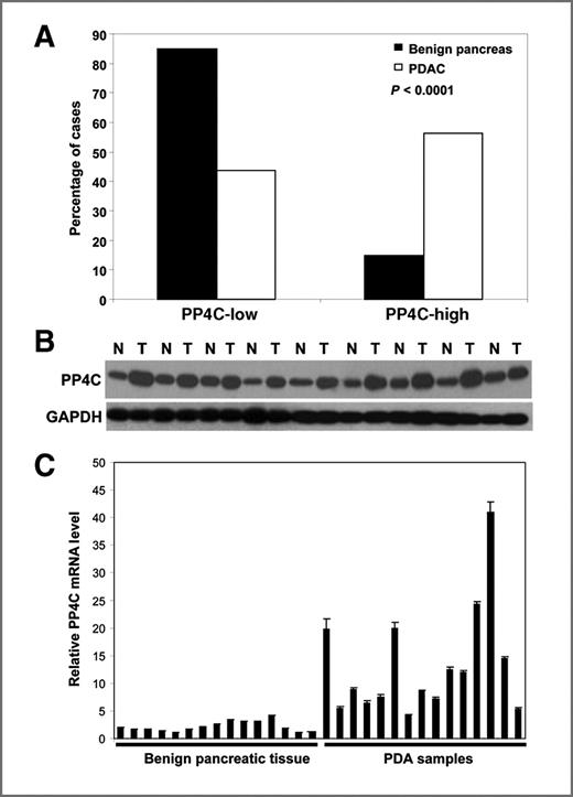 Figure 2. PP4C is overexpressed in PDAC. A, immunohistochemical staining results for PP4C expression in PDAC (N = 133) and their paired benign pancreatic tissue samples (N = 113). The expression of PP4C is significantly higher in PDAC samples than their paired benign pancreatic tissue (P < 0.0001). B, a total of 150 μg of cell lysates from each of 9 PDAC samples and their matched benign pancreatic tissue samples were resolved by 10% SDS-PAGE and immunoblotted with anti-PP4C or anti-GAPDH as loading control. C, Bar graph showing the relative PP4C mRNA expression levels in benign pancreatic tissue samples and PDAC samples measured by real-time qRT-PCR. Relative PP4C mRNA expression levels that were normalized by RPS6 mRNA levels (internal control) were plotted. PP4C mRNA was overexpressed in PDAC samples compared with the benign pancreatic tissue samples. The experiments were repeated 3 times.