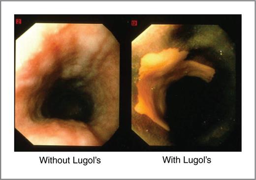 Figure 4. Esophageal squamous dysplasia without and with Lugol's iodine staining. An unstained lesion becomes readily apparent after topical application of Lugol's iodine solution which can then be targeted for biopsy.