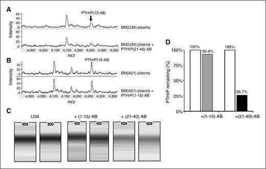 Figure 5. Specific immunodepletion of PTHrP(12-48) from breast cancer patient plasma. A, SELDI profile of unfractionated breast cancer bone metastasis (BM) patient plasma (U34). Top, arrow indicates the m/z 4,260 peak of interest. Bottom, the m/z 4,260 peak is completely abolished by the addition of PTHrP(21-40)AB. B, SELDI profile of unfractionated breast cancer bone metastasis patient plasma (A21). Position of the m/z 4,260 peak of interest is shown. The m/z 4,260 peak is unaffected by the addition of PTHrP(1-15)AB. C, gel view of SELDI spectra from patient U34. Duplicate immune depletion with PTHrP(21-40)AB or PTHrP(1-15)AB. Specificity of PTHrP(21-40)AB is seen. D, quantification of the immunodepletion from (C). Gray bar + (1-15)AB; Black bar + (21-40)AB. Bar labels identify percentage of PTHrP(12-48) remaining after immunodepletion and shows specific immunodepletion of PTHrP(12-48).