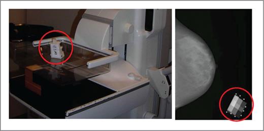 Figure 1. The SXA volumetric density method. Left, the density phantom is affixed to the top compression paddle on an FFDM machine at the University of Vermont Fletcher Allen Health Care Medical Center; Right, the digital mammogram is acquired with the phantom in the corner of the image to allow for automated computation of volumetric mammographic density.