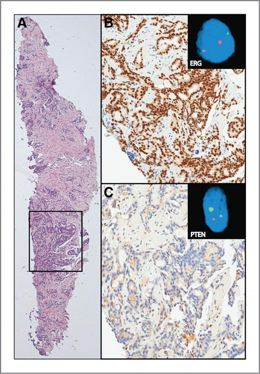 Figure 1. Detection of ERG and PTEN status by IHC and FISH. An ERG+/PTENdel biopsy is represented. A, H&E of needle biopsy showing prostatic adenocarcinoma, Gleason score 7. B, strong, diffuse nuclear ERG IHC staining of tumor glands. ERG break-apart FISH assay showing ERG translocation (inset). C, absence of PTEN IHC staining in tumor glands. FISH assay showing hemizygous PTEN loss (inset).