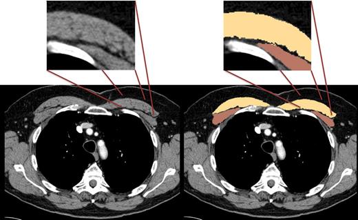 Figure 1. Axial CT images demonstrating measurement of PMA. The areas shaded in yellow are the pectoralis major, whereas the areas in brown are the pectoralis minor. PMA is the sum of the yellow and brown areas. The inset demonstrates the utility of using a priori Hounsfield unit thresholds to define the borders of the pectoralis muscles. This approach allows the border of the muscles to be determined in an unbiased and accurate manner.