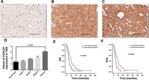 Figure 3. Expression and prognostic value of LGALS3 in glioblastoma. A, Representative staining image of LGALS3 in normal brain. B and C, Representative staining image of LGALS3 in glioblastoma (20×). D, The IHC score of LGALS3 expression in glioblastoma is higher than that in the normal brain, and it is associated with glioma pathologic grade. E and F, Kaplan–Meier analysis shows high expression of LGALS3 related to short PFS and OS of patients with glioblastoma.