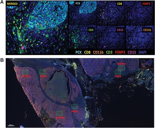 Figure 1. Image analysis of multiplex immunofluorescence panel. A, HGSOC tissue section stained for the seven-marker multiplex immunofluorescence panel. Each marker has a fluorophore that is identified individually (6 panels on the right) and then merged (left). B, Example of the ROI selection for intratumoral and peritumoral ROIs. CD, cell differentiation; INTRA, intratumoral; PERI, peritumoral.