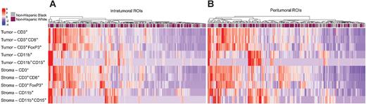 Figure 2. Heatmap of the average immune cell abundance in the tumor and stroma compartments in the intratumoral (A) and peritumoral (B) ROIs annotated by race. Immune cell abundance was standardized by the median and median absolute deviation.