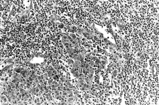 Fig. 1. ESCC with severe lymphocytic infiltration surrounding cancer tissue. H&E, ×200.