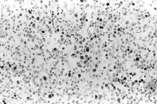 Fig. 2. ISH showed positive EBER-1 signal in the nuclei of positive control tissue that is a posttransplant lymphoproliferative disorder of the liver. ×330.