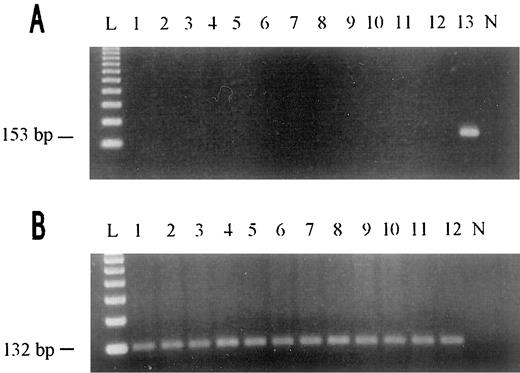 Fig. 4. A, detection of EBV DNA by PCR. None of EBV DNA was amplified in tumor samples (Lanes1-12); Lane 13, positive control DNA. B, β-globin gene was successfully amplified (132 bp) in all of the tumor samples above (Lanes 1-12); Lanes L, 123-bp DNA ladders; Lanes N, negative controls.