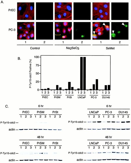 Fig. 4. Cell lines were examined for P-Tyr15-p34/cdc2 labeling by immunostaining cells attached to laminin-coated coverslips. A, samples were immunostained for P-Tyr15-p34/cdc2[green panels in column 2 of each treatment (Control,Na2SeO3, or SeMet)]. Samples were counterstained with DAPI to identify nuclei (blue, column 1 of each treatment) and Alexa 594 conjugated phalloidin, which binds specifically to actin filaments (red, column 1). Data were merged to make a composite image (triple staining: blue, DAPI; red, actin; green, P-Tyr15-p34/cdc2) in each column 1 (each column 2 depicts P-Tyr15-p34/cdc2 data alone). The P-Tyr15-p34/cdc2-labeled areas are white to yellow in color where data were coincident (column 1). Intense greenareas in the general images define data that were not coincidentally merged. Na2SeO3-treated PC-3 cells exhibit distinct actin processes (yellow bracket). SeMet-treated PC-3 cells exhibit cytoplasmic P-Tyr15-p34/cdc2-labeling (white arrows). B, the number of P-Tyr15-p34/cdc2-labeled cells was determined by counting Alexa 488 labeling (average of two experiments). C, selective cdc2 phosphorylation of tumor cells on Tyr15 was examined by immunoblot analysis. B and C: 1,untreated; 2, Na2SeO3; 3, SeMet. Actin levels demonstrate the uniformity of protein loading between treated and untreated sample lanes.