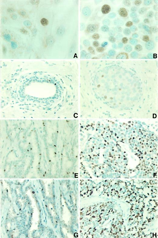 Fig. 1. A few nontumorigenic MCF-10F cells showed moderate nuclear immunostain,whereas most cells were not stained (A). The breast carcinoma-derived T-47D exhibited numerous intensely stained cells (B). Normal ductal epithelium showed very few E2F-1 positive cells (C). The number of positive cells increased in DCIS (D) as well as in low histological grade IDCs(E). Further increase in the percentage of positively stained cells was seen in high-grade invasive ductal carcinomas(F). Mib-1 immunohistochemistry showed similar staining patterns as the E2F-1 immunostain in both low-grade (G) and high-grade (H) breast carcinomas. Immunohistochemistry of E2F-1 and Mib-1 counterstained with hematoxylin. ×450(A–B); ×110 (C); ×220 (D–H).