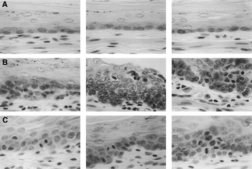 Fig. 2. Histological sections of rat esophageal epithelium at ×1000 stained with H&E. A, portion of normal esophageal epithelium from an age-matched untreated rat at 10 weeks. B, portion of esophageal epithelium from an NMBA-treated rat at 10 weeks showing moderate- to high-grade intraepithelial neoplasia. C,portion of an epithelial plaque from an NMBA-treated rat at 25 weeks showing high-grade intraepithelial neoplasia.