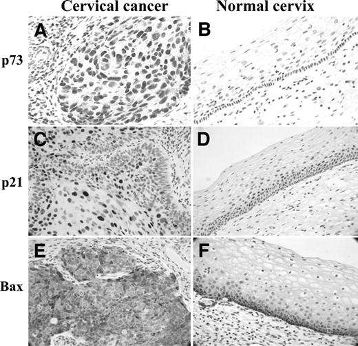 Fig. 2. Immunohistochemical analysis of p73, p21, and Bax expressions in cervical cancer and normal cervix. A, p73 staining was homogeneous, involving all of the cancer cells, whereas (B) the immunoreactivity was less frequently found in normal epithelial cells. C, p21 staining was localized mainly in well-differentiated cancer cells, and (D) in supra-basal and some intermediate layers of normal cervix. E, Bax staining was also homogeneous in cancer cells, and (F) mainly in basal and suprabasal layers of normal cervix.