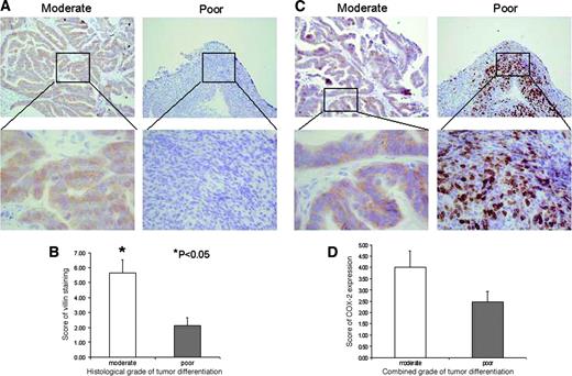 Fig. 2. Immunohistochemistry showing the relationship between tumor differentiation and cyclooxygenase (COX)-2 expression in esophageal adenocarcinoma (AC; n = 30). A, representative immunostaining with the differentiation marker villin in tumors graded histologically as either moderately or poorly differentiated. B, the cumulative data demonstrated increased villin expression in moderately differentiated tumors compared with poorly differentiated tumors (P < 0.05). C, representative COX-2 immunostaining in moderately and poorly differentiated esophageal AC. D, cumulative data showing COX-2 expression in esophageal AC according to their differentiation status (P = nonsignificant).