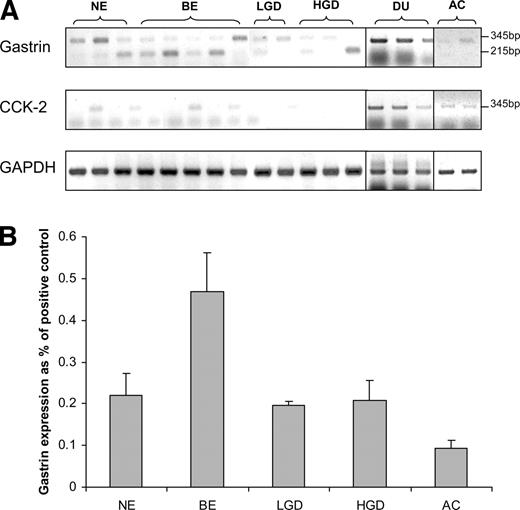Fig. 4. Endogenous expression of gastrin and its cholecystokinin 2 (CCK2) receptor in epithelial cells. A, reverse transcription-PCR for gastrin, CCK2, and glyceraldehyde-3-phosphate dehydrogenase (GAPDH) from normal esophageal squamous epithelium (NE; n = 8), Barrett’s esophageal epithelium (BE; n = 10), dysplastic BE (n = 10), and esophageal adenocarcinoma (n = 4). Three duodenal biopsies were used as a positive control. Gastrin was expressed in all biopsies, with variable expression of the CCK2 receptor between patients. Glyceraldehyde-3-phosphate dehydrogenase is a loading control. B, cumulative data of gastrin expression in biopsies. There was a 2-fold increase in gastrin mRNA levels in nondysplastic BE compared with other groups (P = 0.1). Data are presented as a percentage of the positive duodenal control.