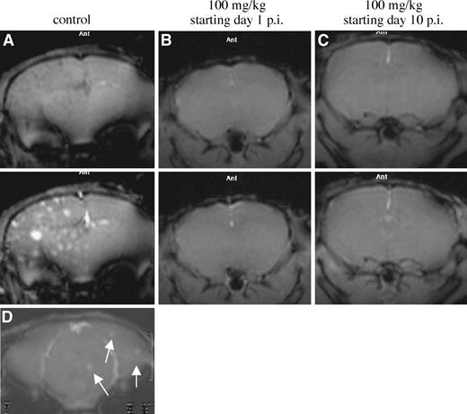 Fig. 2. Effects of ZD6474 treatment of Gd-DTPA-enhanced MRI. Before sacrifice, control-treated (A) and ZD6474-treated (B and C) mice were subjected to CE-MRI as described in the text. Treatment was initiated at day 2 (B) or 10 (C) after injection. The images shown were acquired before (A−C, top panels) and 2 minutes after (A−C, bottom panels) injection of Gd-DTPA in the tail vein. Note the enhancement in meningeal vessels in B and C, indicating that Gd-DTPA did enter the circulation in these mice. D, MRI image of mouse brain containing Mel57-VEGF-A lesions, recorded 12 days after injection of tumor cells. Image was taken immediately after injection of Gd-DTPA. Arrows indicate small lesions.