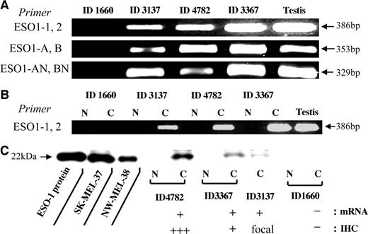 Fig. 1. Analysis of NY-ESO-1 expression were examined by RT-PCR (A and B) and by Western blot (C) analysis. In A, RNA extracted from esophageal cancer specimens ID1660, ID3137, ID4782, and ID3367 were examined by RT-PCR with three sets of primer pairs; ESO1–1 and ESO1–2, ESO1-A and ESO1-B, and ESO1-AN and ESO1-BN. In B, normal (N) and cancer (C) tissues from the same surgical specimens ID1660, ID3137, ID4782, and ID3367, were examined by RT-PCR. In C, ES121-reactive band was observed at 22 kDa in cancer tissues (C) from ID4782, ID3367, and ID3137 but not in normal esophageal tissues (N) and in a NY-ESO-1 mRNA-negative cancer (ID1660). ESO-1 protein, recombinant protein. SK-MEL-37 and NW-MEL-38, NY-ESO-1 expressing cell lines.