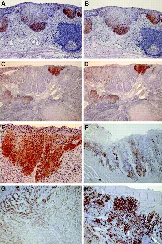Fig. 3. Immunohistochemical staining. Five esophageal cancer specimens (ID5512, A and B; ID3137, C–E; ID3367, F; ID3001, G; ID4782, H) were shown. Staining was done using monoclonal antibodies ES121 (A, C, and E–H) and E978 (B and D). A–E showed focal staining (<5% of cells stained). F showed + (5 to 25% of cells stained). G showed ++ (25 to 50% of cells stained). H showed +++ (>50% of cells stained). No cells were stained in normal esophageal epithelium. Magnification: ×40 (A–D and F–H); ×200 (E).