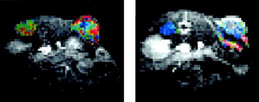 Fig. 4. The typical Vascular targeting agent (VTA)-induced reduction in contrast agent enhancement measured as the integrated area under the curve (IAUC) using dynamic contrast enhanced magnetic resonance imaging. A mouse bearing a s.c. C38 colon adenocarcinoma in the flank was imaged before (left) and 24 h after (right) treatment with ZD6126. Transaxial images through the abdomen are shown, with the dorsal surface orientated upwards and the abdominal cavity downwards in the figure. The tumor is visible as the colored area in the top right of the figure. The colored area on the top left is paravertebral muscle. The color scale for IAUC increases from blue to green to yellow to red. ZD6126 treatment led to a reduction in IAUC. With thanks to Zach DelProposto (Wayne State University, Detroit, MI) and Jeff Evelhoch (Pfizer, Inc., Ann Arbor, MI) for supplying the figure.
