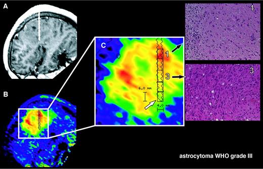 Fig. 1. Illustration of image processing. Biopsy trajectory is projected into the preoperative MRI image (A). The [11C]MET-PET image is resliced to fit to the magnetic resonance image, and the biopsy trajectory is visualized and projected into the fused PET/magnetic resonance image (B). Magnification of [11C]MET-PET (C) demonstrates how regions of interest were defined. A rectangular region of interest with 4 mm in width and the individual length of each specimen (C, in this example, 6 mm, white arrow) are placed at the exact position of each biopsy specimen, and the mean [11C]MET uptake was calculated. This patient was newly diagnosed with astrocytoma grade 3 showing no contrast enhancement on MRI (A). [11C]MET uptake was higher in the area of tumor infiltration (biopsy 1) compared with solid tumor (biopsy 3).