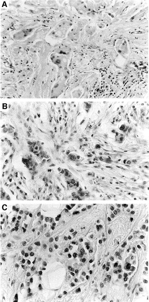 Fig. 4. Immunohistochemical analysis of HMGA1 expression in breast ductal carcinomas (G3). A, immunostaining of a G3 ductal carcinoma with only a few stained cells. B, immunostaining of another G3 ductal carcinoma with more immunostained cells versus the sample shown in A. C, immunostaining of a third G3 ductal carcinoma showing intense immunoreactivity and more immunostained cells versus the samples shown in A and B.