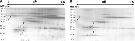 Fig. 2. Differential expression of proteins in cancerous versus benign NAF. Matched NAF samples [normal breast (A) and breast with cancer (B)] from the same subject were separated on a 3-to-10, 24-cm immobilized pH gradient (IPG) strip and were separated on an 8-to-18% gel chip. The regions around each spot are shown in the normal versus the cancer sample, and the proteins selected are marked by corresponding arrows. These protein spots were excised and subjected to MALDI-TOF MS analysis, and were identified as prolactin-induced protein (spot 1), apoD (spot 2), and α1-acid glycoprotein, respectively (spot 3). (kDa, molecular weight (MW) in thousands.)
