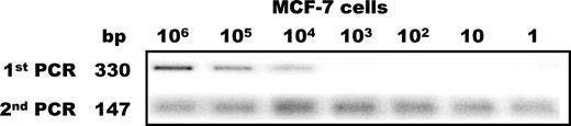 Fig. 1. Nested RT-PCR of total RNA decreasing dilutions of the MCF-7 breast carcinoma cell line showing amplification of the HER-2 mRNA signal in the second PCR down to the dilution of one tumor cell (1 of 5 experiments).