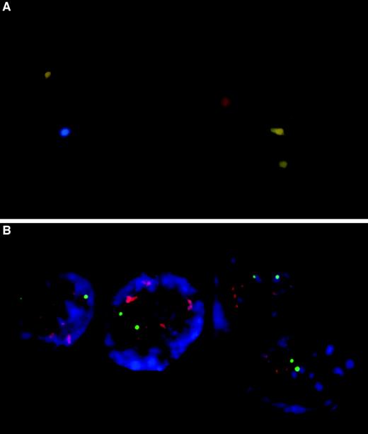 Fig. 2. A. Four breast cancer cells with HER-2/neu amplification (>10 orange signals per cell) in a FISH preparation with PathVysion HER-2 DNA probe. B. Two breast cancer cells with aneusomy in chromosomes 8 (red signal), 11 (green signal), and 17 (aqua signal) in a FISH preparation with Breast Aneusomy probe set from Vysis.