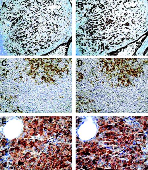 Fig. 2. Comparison of reactivity of two anti–NY-ESO-1 mAbs; ES978 (A, C, and E) and ES121 (B, D, and F) on melanoma tissue tested by immunohistochemistry.