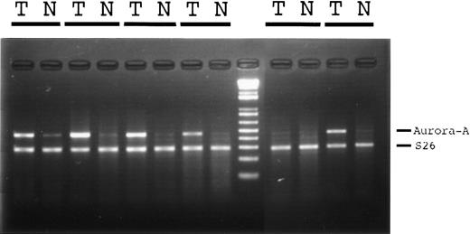 Fig. 1. Aurora-A mRNA expression in paired hepatocellular carcinoma (T) and nontumorous liver parenchyma (N). Quantitative reverse transcription-PCR measurement of Aurora-A mRNA during the exponential phase of reverse transcription-PCR amplification of mRNA showed Aurora-A overexpression in 5 of 6 hepatocellular carcinoma specimens.