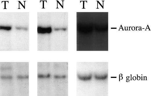 Fig. 7. Southern blot hybridization demonstrated amplification of Aurora-A in 3 tumors (T, tumor; N, nontumorous liver parenchyma). β-Globin served as a control for DNA quantity.