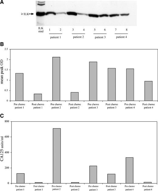Fig. 5. Effect of chemotherapy on the expression of immunoreactive integrin-linked kinase (irILK) in the serum of ovarian cancer patients. A, matching serum samples from patients with grade 1 ovarian cancer before and after six cycles of carboplatin/Taxol were resolved by Western blotting. Lanes 1, 3, and 7 are serum samples from patients diagnosed with grade 1 ovarian cancer before the surgery. Lanes 2, 4, and 8 are the matching serum samples from the same patients after surgery and six cycles of chemotherapy. Lanes 5 and 6 are matching serum samples from a patient diagnosed with grade 1 ovarian cancer before and after surgery and two cycles post chemotherapy. B, quantification of irILK expression in the serum samples was performed by densitometry and expressed as peak optical density (OD) ± SE of the number of samples described above. C, the quantitative determination of cancer antigen 125 (CA 125) levels in the matching serum samples of patients with grade 1 ovarian cancer.