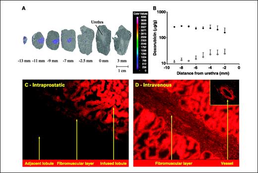 Fig. 3. Spatial doxorubicin distribution: confocal fluorescence microscopic results. Animals were treated with doxorubicin and the prostates were harvested, frozen, and cryosectioned as described in Fig. 2. A, fluorescence image of each microscope section was overlaid with the transmission image of the same slides. Representative dog images. The distance from the urethra is indicated for each section, with negative numbers indicating the sections (right), where the injection took place. Fluorescence intensity is represented by pseudocolors. B, confocal fluorescence images were analyzed for concentrations in the injected lobule (•), and in neighboring lobules (○). The drug concentration within the injected glandular lobule was relatively constant, with a 26-fold drop across the fibromuscular layer near the capsule, declining to a 6-fold drop near the urethra. Distance is relative to the urethra (0 mm). Points, mean (n ≥ 4); bars, ±SE. C, prostatic cross-section of an animal receiving an intraprostatic doxorubicin infusion shows a heterogeneous distribution with a steep fluorescence intensity gradient across the fibromuscular stroma. D, doxorubicin, 16 mg/kg, was injected by i.v. bolus administration in a dog. Fifteen minutes later, the prostate was harvested and subsequently cryosectioned for fluorescent microscopy. Note the even distribution in the adjacent glandular tubules after the i.v. infusion. A blood vessel in the fibromuscular stroma, surrounded by cells exhibiting high fluorescent intensity (inset, arrow). Original magnification 100×. Exposure time, 30-fold longer than for panel (C).