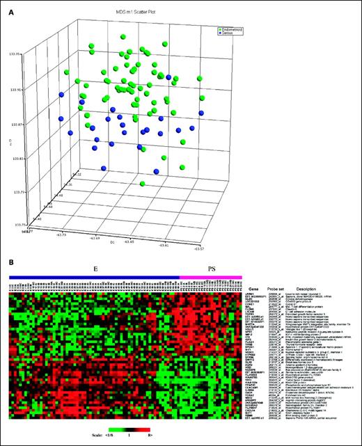Fig. 1. A, unsupervised analysis using multidimensional scaling based on the overall gene expression in endometrioid (green) and papillary serous (blue) using 1-correlation as distance metric of 18.4 K transcripts detected in at least 50% of the arrays. B, differentially expressed genes between 66 endometrioid carcinomas and 24 papillary serous carcinomas. Twenty-five most up-regulated and 25 most down-regulated genes at P < 0.001. Each sample in the heat map is labeled histology, stage of disease, and coded tumor number. The heat map was color coded using red for up-regulation from normal endometria and green for down-regulation.