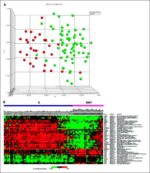 Fig. 2. A, unsupervised analysis using multidimensional scaling based on the overall gene expression in endometrioid carcinomas (red) and mixed mullerian tumor (blue). B, genes differentially expressed between 66 endometrioid carcinomas (E) and 29 mixed mullerian tumors (MMT) of the uterus. Twenty-five most up-regulated and 25 most down-regulated genes at P < 0.001. Each sample in the heat map is labeled histology, stage of disease, and coded tumor number. The heat map was color-coded using red for up-regulation from normal endometria and green for down-regulation.