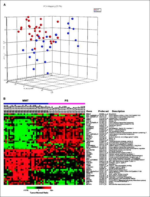 Fig. 3. A, unsupervised analysis using multidimensional scaling based on the overall gene expression in mixed mullerian tumor (red) and papillary serous carcinoma (blue). B, list of 25 highest and 25 lowest differentially expressed genes (at least 2-fold) for 29 mixed mullerian tumors and 24 papillary serous (PS) carcinomas (P < 0.001). Each sample in the heat map is labeled histology, stage of disease, and coded tumor number. The heat map was color coded using red for up-regulation from normal endometria and green for down-regulation.
