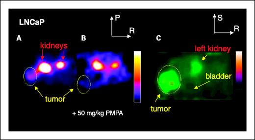 Fig. 1. A, axial advanced technology laboratory animal scanner PET images of [11C]DCMC in mouse kidney and LNCaP tumors without and with (B) coinjection of 50 mg/kg PMPA to block PSMA. Note the decrease in tumor as well as renal radiopharmaceutical uptake on blockade in (B). C, magnified, coronal reconstructed image of animal in (A) outside of the plane of the kidneys immediately after urination indicates lack of specific binding to bladder. Tumor was clearly visualized as well as a portion of the left kidney. Images (A and B) are scaled to the same maximum. P, posterior; R, right; S, superior.