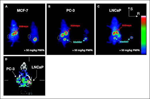 Fig. 2. Planar gamma scintigraphy of [125I]DCIT in mouse kidney and tumors without (left mouse) and with (right mouse) coinjection of 50 mg/kg PMPA. Tumor is within dashed circles. Again, note decreased radiopharmaceutical uptake within kidneys on blockade. Only the LNCaP tumor was visualized (C). SPECT with computed tomography overlay (D) further shows the LNCaP tumor, whereas the PC-3 tumor retains only minimal radiotracer. Images (A-C) are scaled to the same maximum (bladder or kidney).