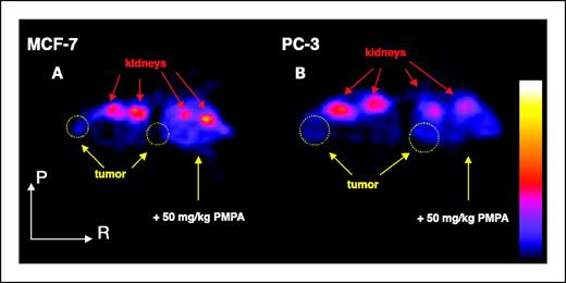 Fig. 4. Axial 1advanced technology laboratory animal scanner PET images of [11C]DCMC in (A) MCF-7 and (B) PC-3 tumor-bearing mice. Pre-blockade images (left mouse) and those with coinjection of 50 mg/kg PMPA blocker (right mouse). PMPA decreased uptake within renal cortex (site of proximal tubules, replete with PSMA), but neither of these PSMA-negative tumors could be imaged clearly with this agent.