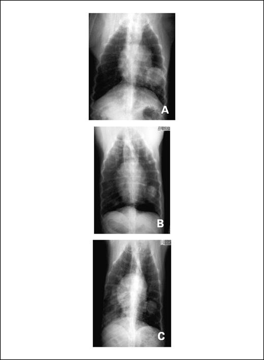 Fig. 1. Dorsoventral thoracic radiographs from a dog with primary pulmonary angiosarcoma following VNP20009 treatment. A, pretreatment. B, 21 days following treatment initiation. Regression of the pulmonary nodule in the left caudal lung field can be seen. C, 42 days following treatment initiation. Sustained regression of the presumed primary angiosarcoma is seen, in the face of progression of intrathoracic metastatic disease.