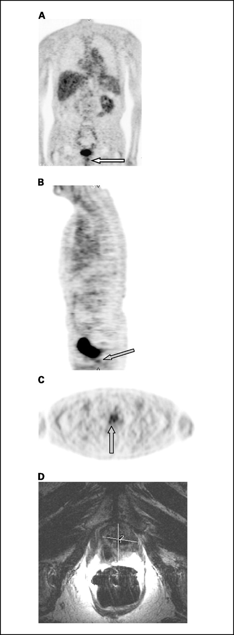 Fig. 2. Coronal, sagittal, and transaxial FDG-PET images (A-C) for a 79-year-old man with increasing serum PSA of 6.24 ng/mL, 9 years after radical prostatectomy. There is focal FDG accumulation in the prostate bed (arrow). Concurrent transaxial MRI (D; T2-weighted image) showed a mass in the same location. The patient subsequently underwent radiation therapy to the prostate bed; afterward, his PSA decreased to 0.09 ng/mL.