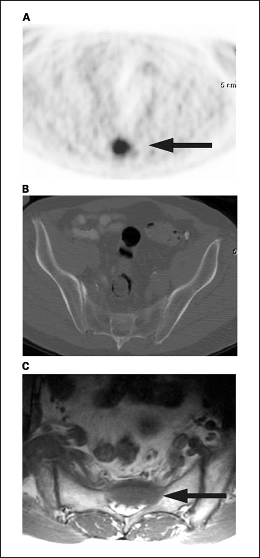 Fig. 3. Transaxial FDG-PET (A), CT (B), and MRI (C) images of a 68-year-old man with PSA relapse (PSA = 2.85 ng/mL) 3.4 years after radical prostatectomy. Histologic diagnosis showed Gleason score of 4 + 4 at time of treatment. PET shows abnormal FDG uptake in the sacrum; CT image shows no clear abnormality; MRI image (T1-weighted image) shows signal abnormality (dark) that corresponds to the site of abnormal FDG uptake in the PET image.