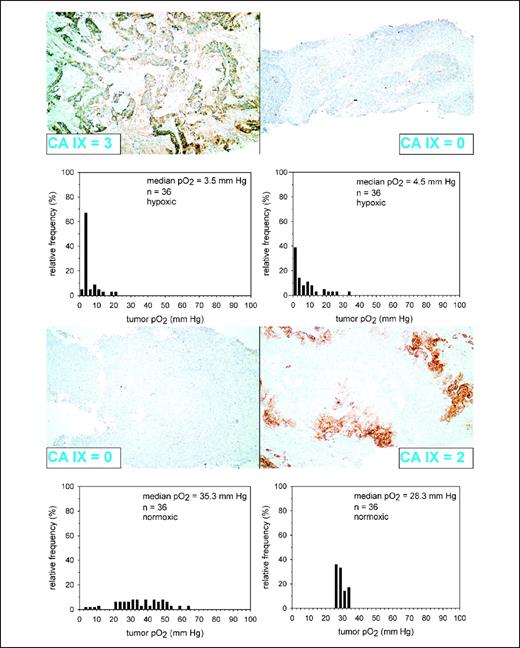 Fig. 1. Expression patterns and score of CA IX expression (histologic photographs; magnification, ×10) with respective oxygen tension (pO2) histograms for hypoxic (top) and normoxic tumors (bottom). Examples of high and low expression of CA IX are depicted. n, number of pO2 readings in the respective measurement track.