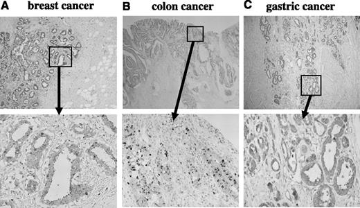 Fig. 1. Immunohistochemical staining of survivin protein in surgically resected specimens. Expression of survivin protein in breast (A), colorectal (B), and gastric cancer (C) specimens was assessed by standard immunohistochemical staining method as described in Materials and Methods. Photographs in the lower column are magnified views of boxes in the upper column.