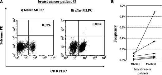 Fig. 2. Frequency analysis of CTLp in HLA-A24+ breast cancer patients. Frequency of the CTLp specific for survivin-2B80-88 peptide in PBMC before and after MLPC was analyzed by using HLA-A24/survivin-2B80-88 peptide tetramer. Cells were stained with the phycoerythrin (PE)–labeled tetramer and FITC-conjugated anti-CD8 monoclonal antibody followed by flow cytometric analysis. Frequency was calculated as the number of tetramer-positive cells divided by the number of CD8+ cells. A, representative dot plots of CTLp frequency analysis before and after MLPC of PBMC from breast cancer patient 3. Tetramer staining intensity is shown on the Y axis and CD8 staining is shown on the X axis. Number in the top right quadrant, percentage of HLA-A24/survivin-2B8-88 peptide tetramer-positive cells in CD8+ cells. B, individual trace of CTLp frequency before and after MLPC of PBMC from six breast cancer patients.