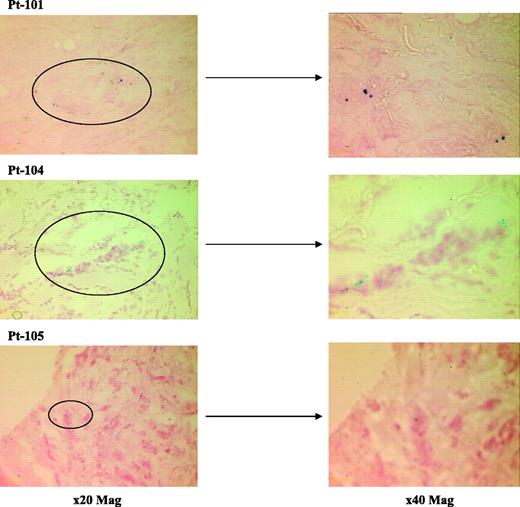 Fig. 1. Histologic sections showing gene expression. Photomicrographs illustrating representative sections from biopsies taken from three patients after intratumoral injection of MetXia-P450. Cells are stained with X-gal for the expression of β-galactosidase as described in Patients and Methods. The presence of blue cells indicates gene expression from E. coli lacZ.
