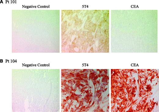 Fig. 3. Tumor antigen profiling of patient biopsies by immunohistochemistry. Photomicrographs illustrate immunohistochemical staining of tumor biopsies recovered from patients 101 (A) and 104 (B) for expression of h5T4 and CEA.