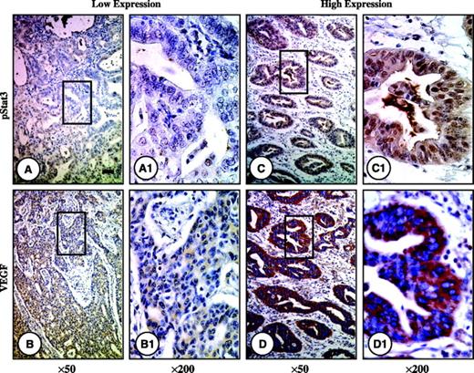 Fig. 1. pStat3 and VEGF protein expression in human gastric cancer tissue. Two sets of consecutive tissue sections of high and low Stat3 expression were prepared from formalin-fixed, paraffin-embedded specimens of gastric cancers. Immunohistochemical staining done using specific antibodies against phospho-Stat3 and VEGF. A1, B1, C1, and D1 (original magnification: ×200), representative areas from A, B, C, and D (original magnification: ×50), respectively. Of note is that high Stat3 expression directly correlated with increased VEGF expression.