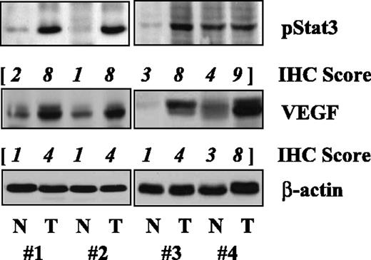 Fig. 2. pStat3 and VEGF protein expression in human gastric cancer tissue. Whole-cell protein extracts were prepared from four paired normal gastric (N) and gastric tumor tissue (T) specimens obtained from the patients with pStat3 and VEGF expression detected via immunostaining [immunohistochemical (IHC) scores in italics]. The level of expression of pStat3 and VEGF protein was determined using Western blot analysis with 10-μg whole cell protein extracts. Equal protein sample loading was monitored by hybridizing the same membrane filter with an anti-β-actin antibody. Of note is that the levels of both pStat3 and VEGF protein expression were significantly elevated in tumor tissue compared with normal tissue.